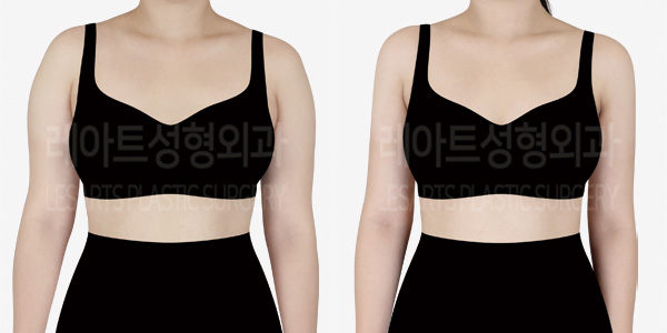 arm_liposuction_01_thumbnail_241017