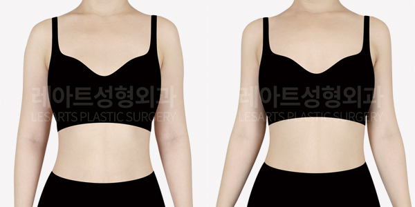 arm_liposuction_01_thumbnail_241101