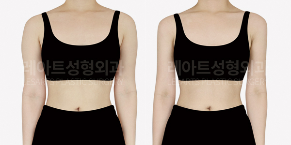 arm_liposuction_01_thumbnail_241128
