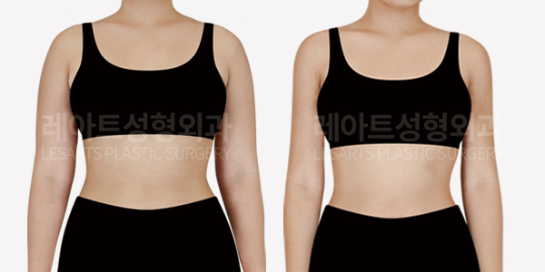arm_liposuction_01_thumbnail_241202