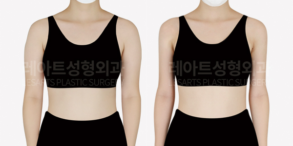 arm_liposuction_01_thumbnail_250102