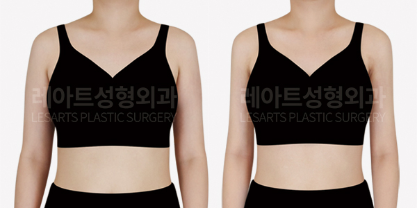 arm_liposuction_01_thumbnail_250107