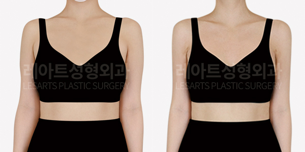 arm_liposuction_01_thumbnail_250110