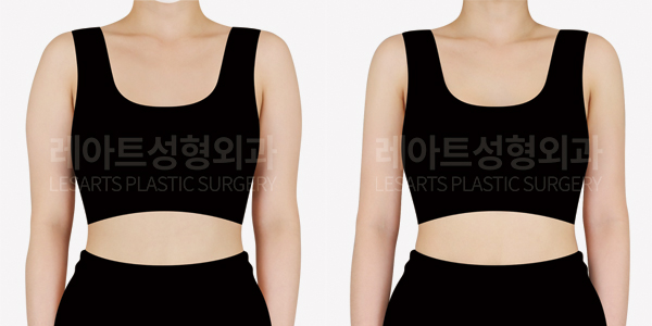 arm_liposuction_01_thumbnail_250205