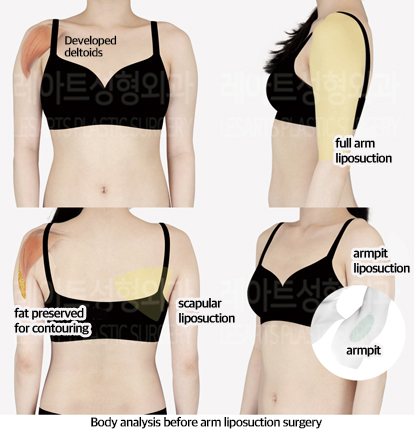 arm_liposuction_02_01_240826