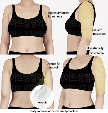 arm_liposuction_02_01_240911