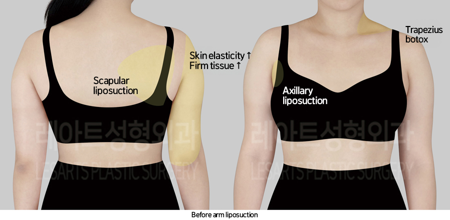 arm_liposuction_02_01_241017