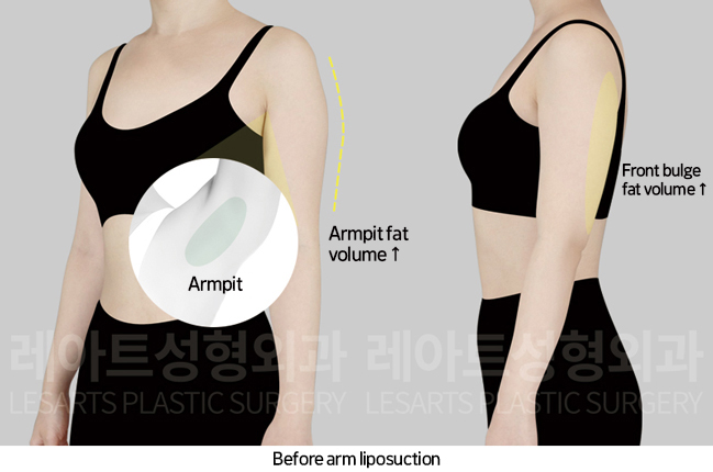 arm_liposuction_02_01_241101