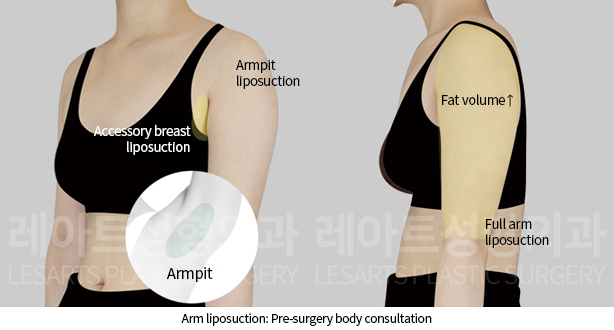 arm_liposuction_02_01_241128