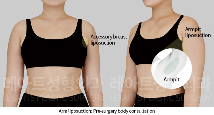 arm_liposuction_02_01_241202