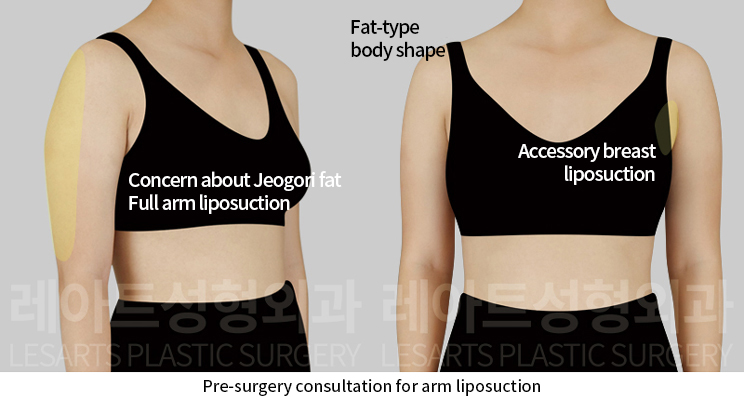 arm_liposuction_02_01_241224