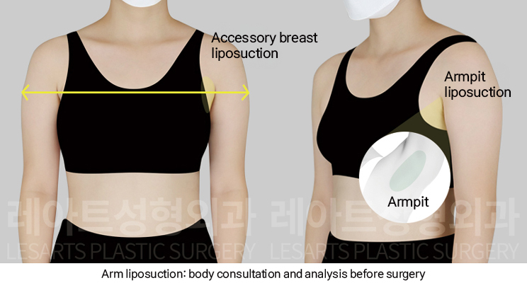 arm_liposuction_02_01_250102