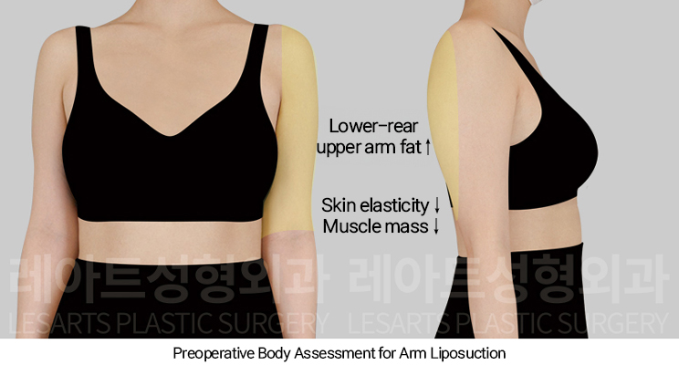 arm_liposuction_02_01_250110