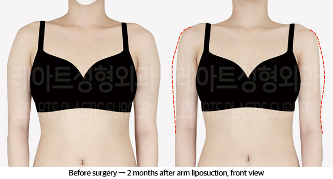 arm_liposuction_02_02_240826
