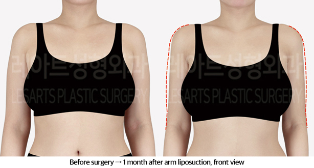 arm_liposuction_02_02_240911