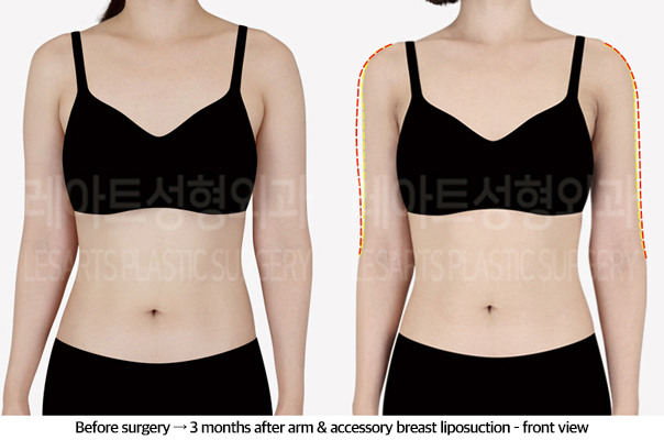 arm_liposuction_02_02_240920