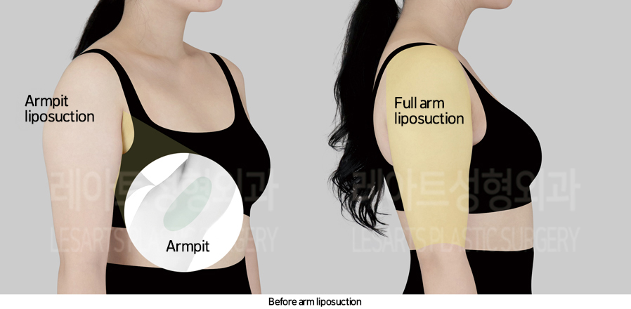 arm_liposuction_02_02_241017