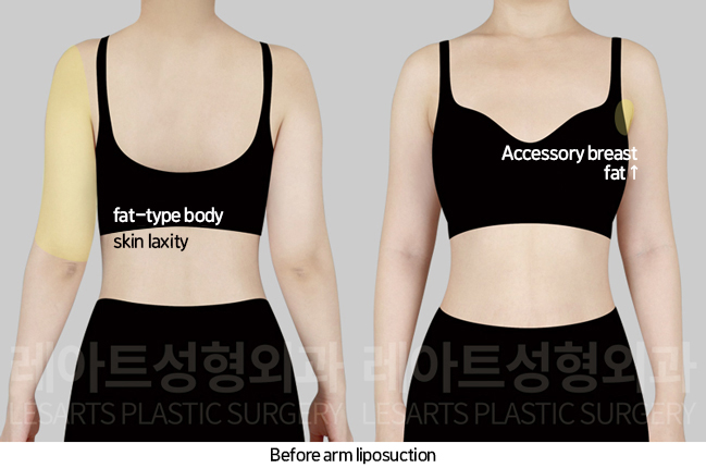 arm_liposuction_02_02_241101
