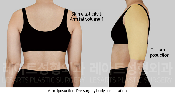 arm_liposuction_02_02_241202
