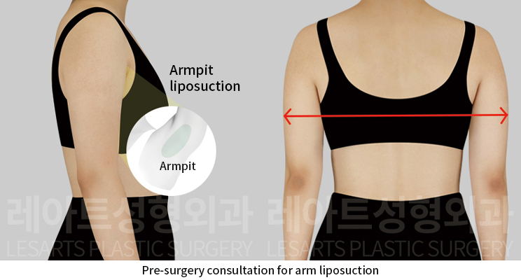 arm_liposuction_02_02_241224