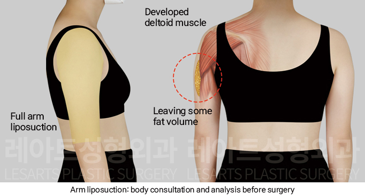arm_liposuction_02_02_250102