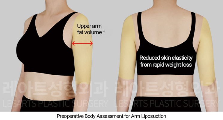arm_liposuction_02_02_250107
