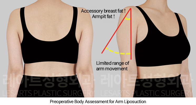 arm_liposuction_02_02_250110