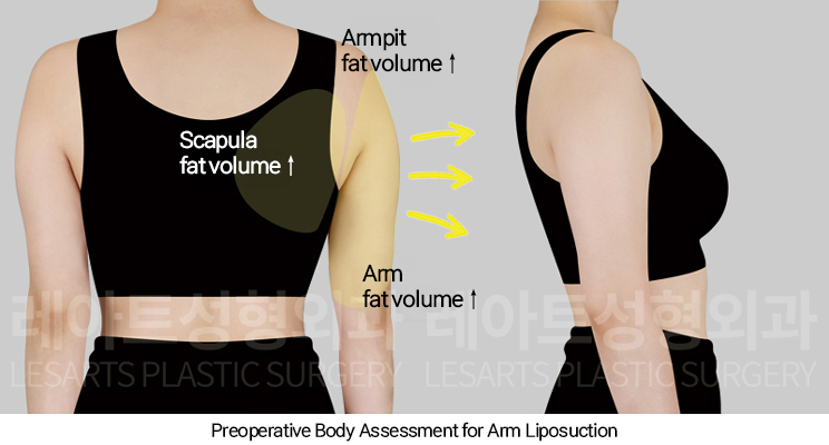 arm_liposuction_02_02_250205