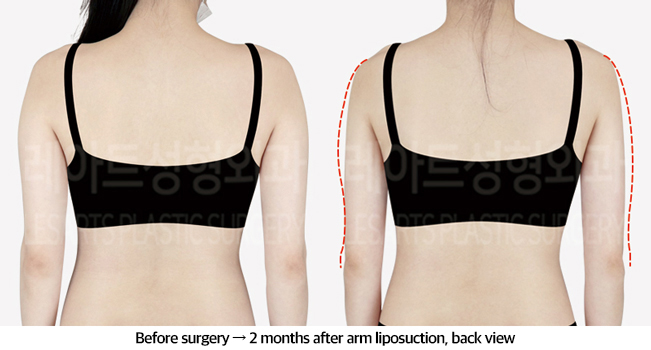 arm_liposuction_02_03_240826
