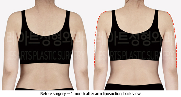 arm_liposuction_02_03_240911