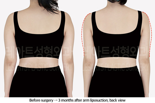 arm_liposuction_02_03_240913