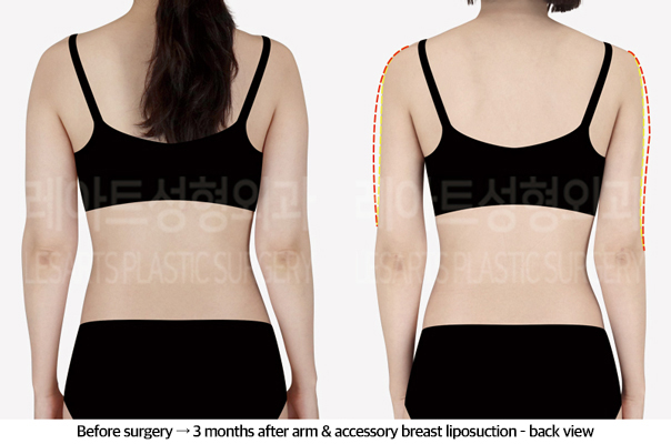arm_liposuction_02_03_240920