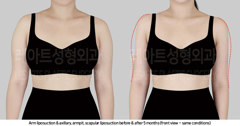 arm_liposuction_02_03_241017