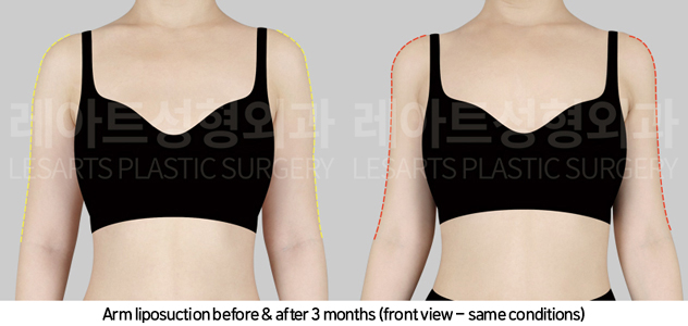 arm_liposuction_02_03_241101