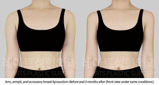 arm_liposuction_02_03_241128