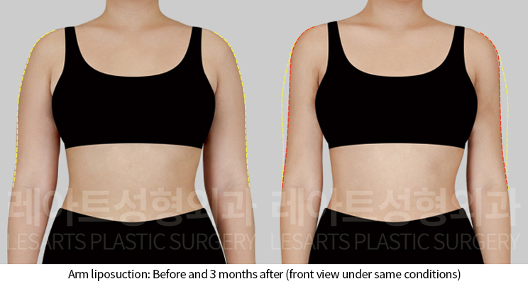 arm_liposuction_02_03_241202