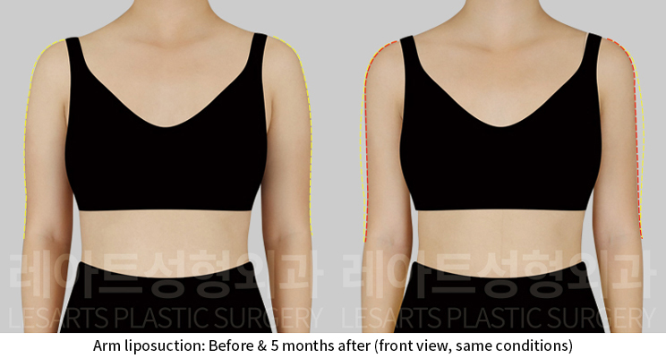 arm_liposuction_02_03_241224