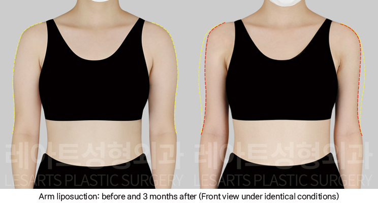 arm_liposuction_02_03_250102