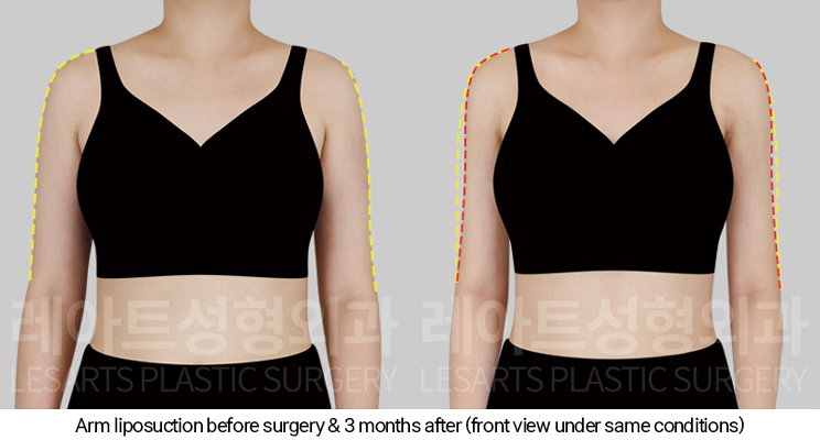 arm_liposuction_02_03_250107