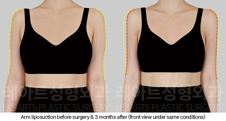 arm_liposuction_02_03_250110
