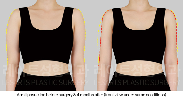 arm_liposuction_02_03_250205