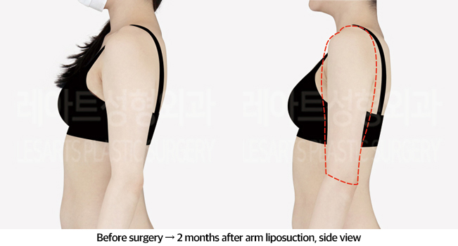 arm_liposuction_02_04_240826
