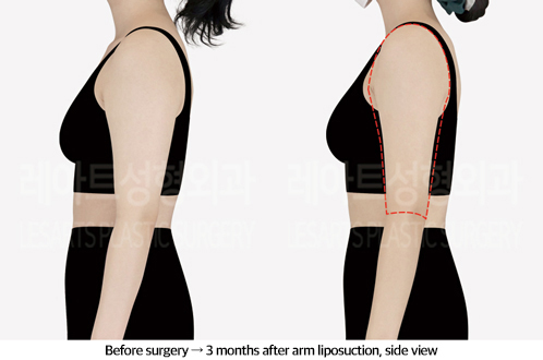 arm_liposuction_02_04_240913
