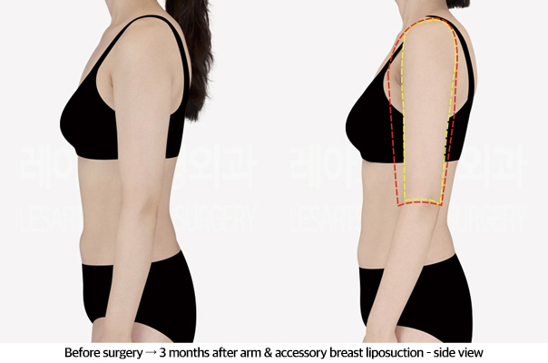 arm_liposuction_02_04_240920