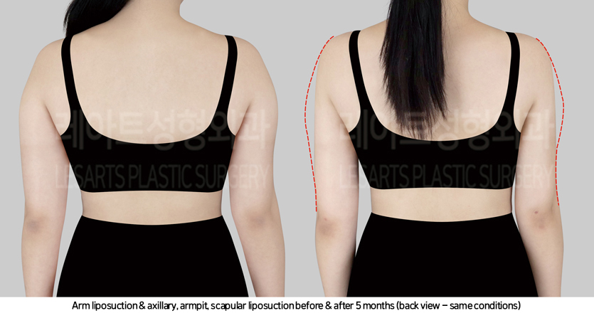 arm_liposuction_02_04_241017