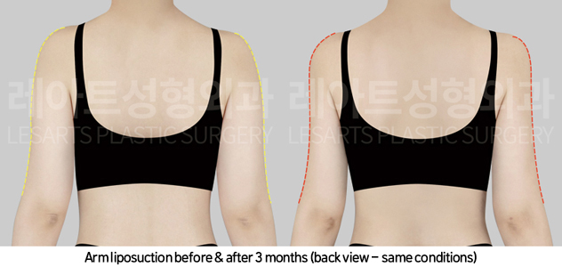 arm_liposuction_02_04_241101