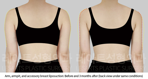 arm_liposuction_02_04_241128