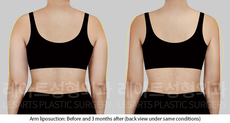 arm_liposuction_02_04_241202