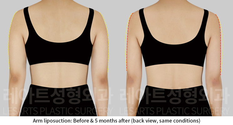 arm_liposuction_02_04_241224