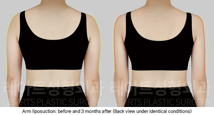 arm_liposuction_02_04_250102